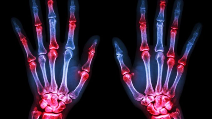 Ciertos pacientes con artritis reumatoide mejoraron más rápido con ...
